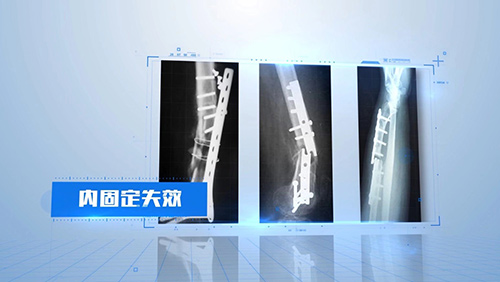 OBS桥接组合式内固定系统